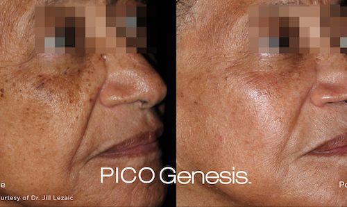 dark spots face treatment before after mississauga oakville